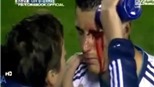 Chấn thương mắt, Ronaldo rút khỏi ĐT BĐN